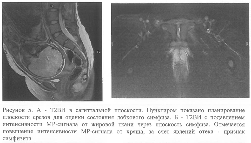 Фиброаденома молочной железы